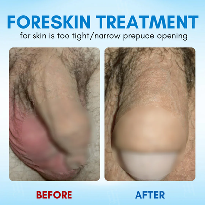 RZXEA™ Foreskin Elasticity Gel